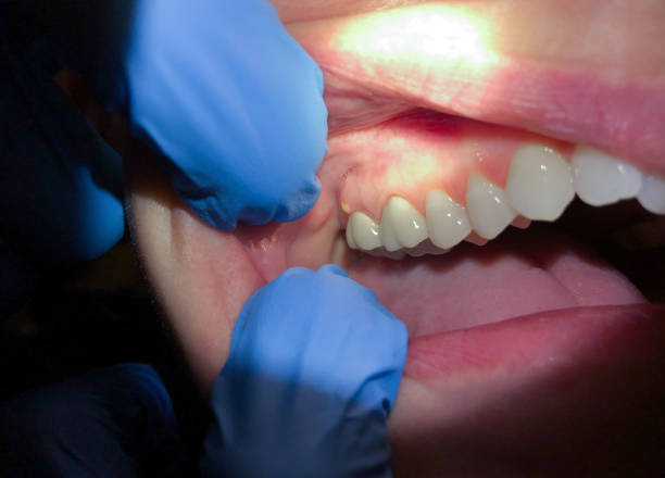 Best Emergency Gum Treatment in Stevensville, MT
